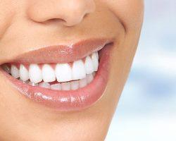 How Much Does Teeth Whitening Cost In Canada?