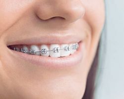 Cost of Braces in South Africa 2022/2023